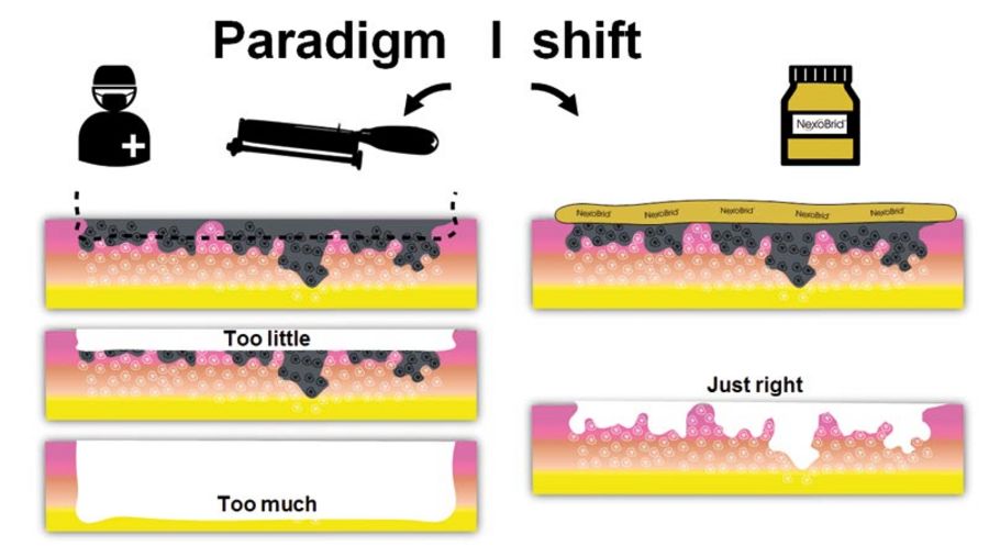 MediWound Paradigmenwechsel MediWound Paradigmenwechsel
