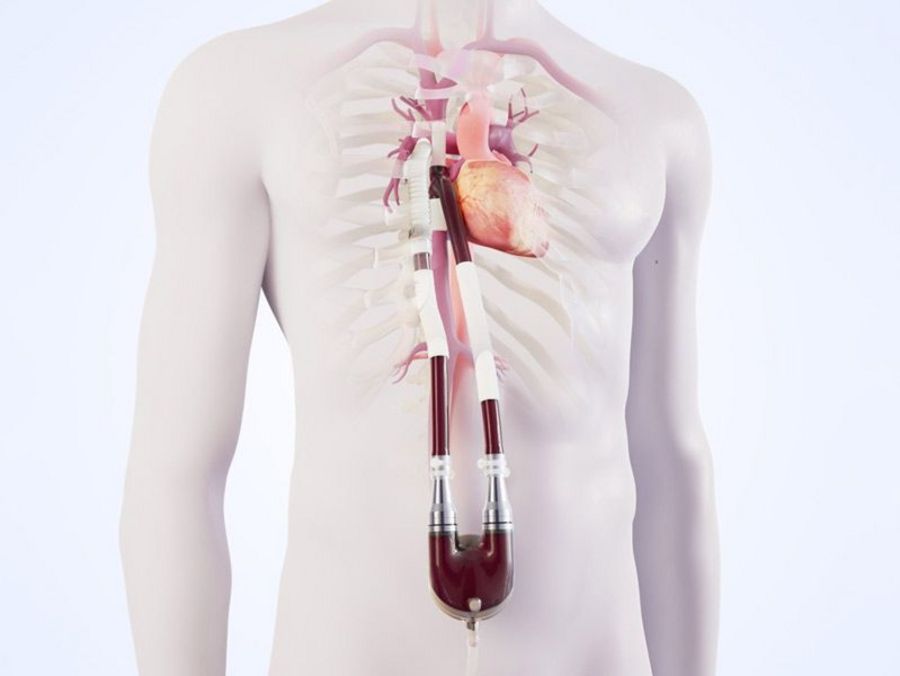 Berlin Heart - EXCOR® Revive System Berlin Heart - EXCOR® Revive System