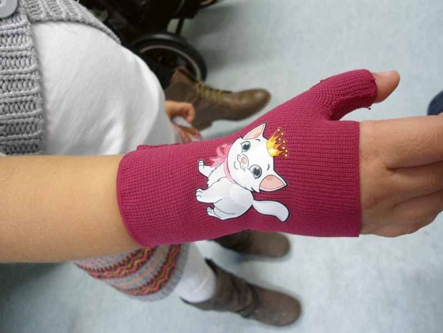 Sanitätshaus Fuchs+Möller Narbenkompression für eine Kinderhand Sanitätshaus Fuchs+Möller Narbenkompression für eine Kinderhand