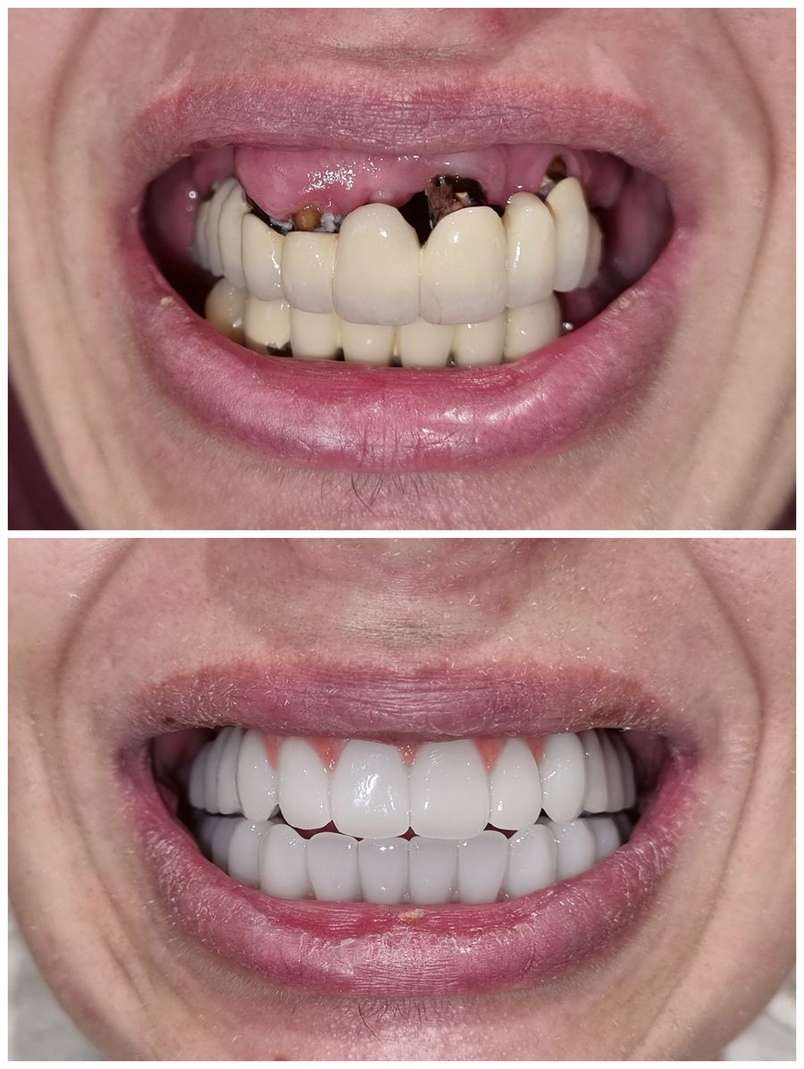 Dr. Ihde Dental AG Behand vorher nachher Dr. Ihde Dental AG Behand vorher nachher